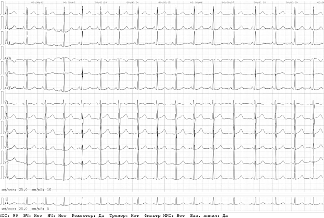 Показатели ЭКГ