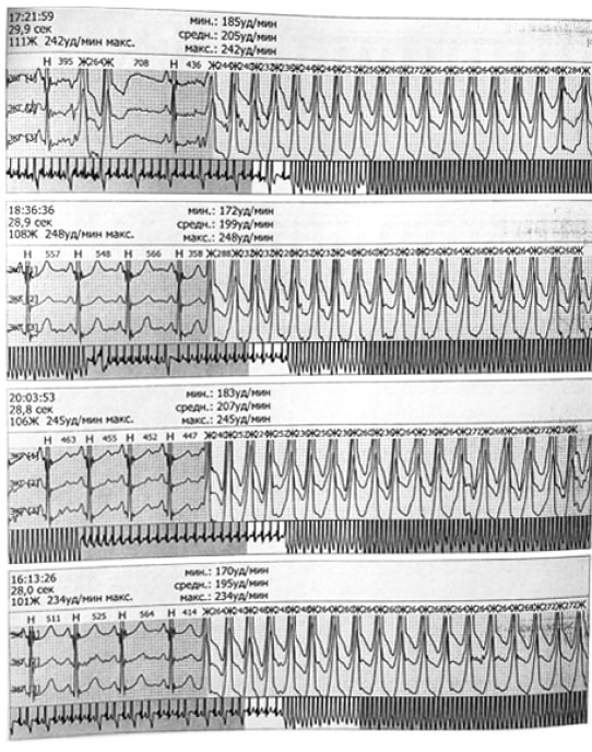 Показатели ХМЭКГ