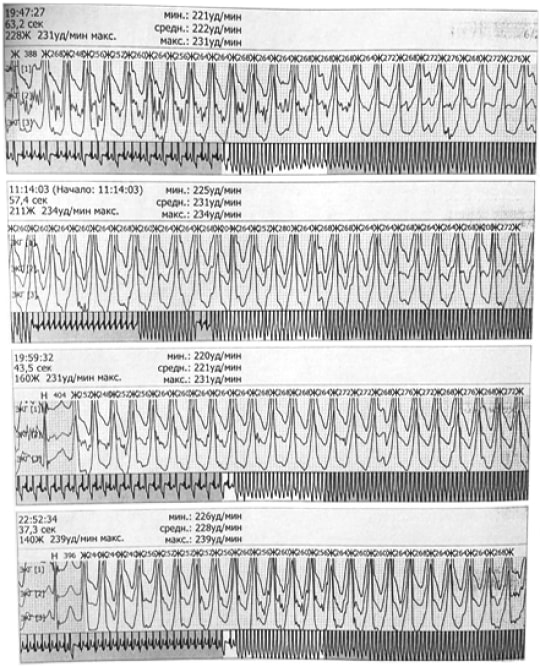 Показатели ХМЭКГ
