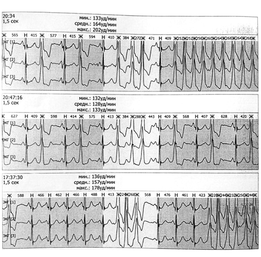 Показатели ХМЭКГ