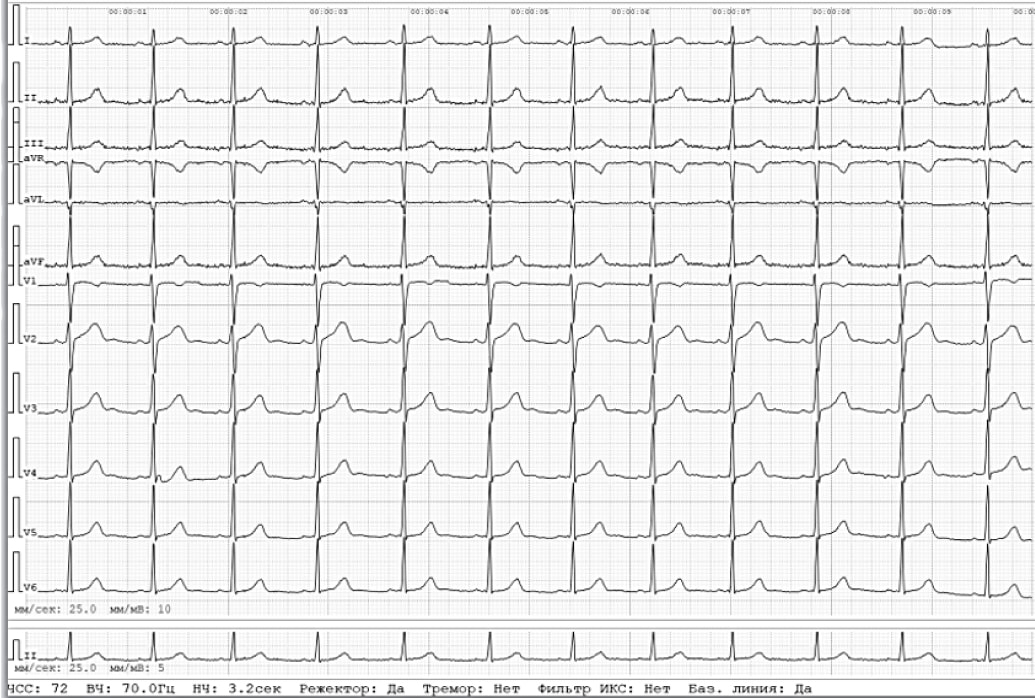 Показатели ЭКГ